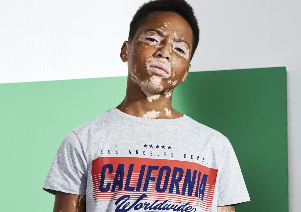 Dating-Websites vitiligo