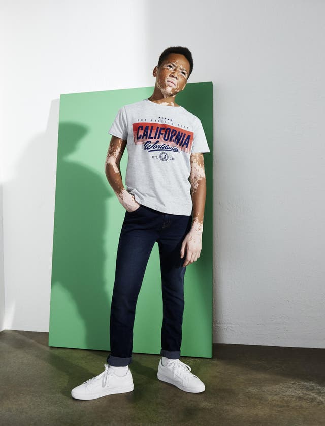Primark praised for featuring model with vitiligo in fashion campaigns ...