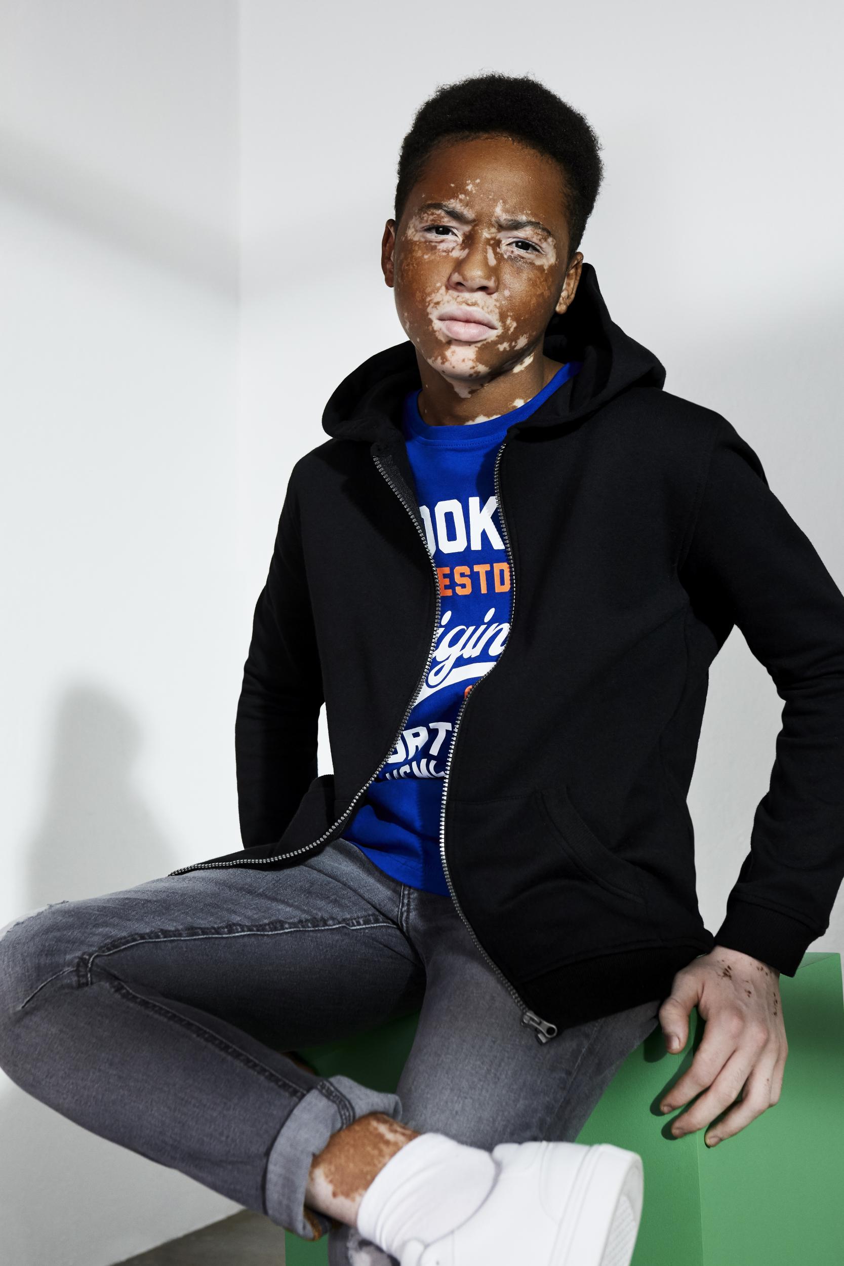 The campaign featuring a boy with vitiligo has been described as 'super beautiful'