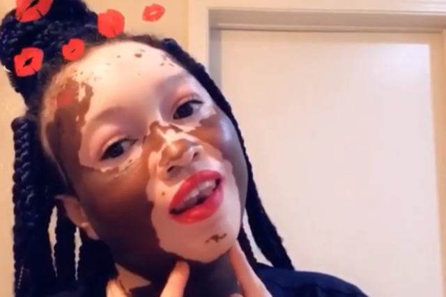 Iomikoe Johnson has embraced her vitiligo (Instagram)