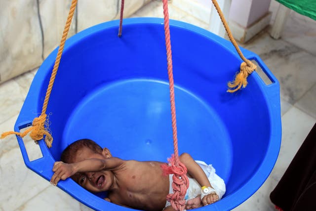 A Yemeni child suffering from severe malnutrition is weighed at a hospital in Yemen’s northwestern Hajjah province, where a camp for the displaced was hit by shelling this week