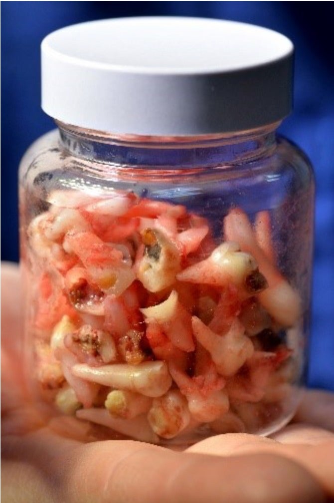 Jar of decayed teeth, including 16 from a two-year-old child, removed during a single afternoon in surgery by Claire Stevens CBE, paediatric dental consultant also known as ‘the tooth fairy’ (Claire Stevens CBE, British Society of Paediatric Dentistry