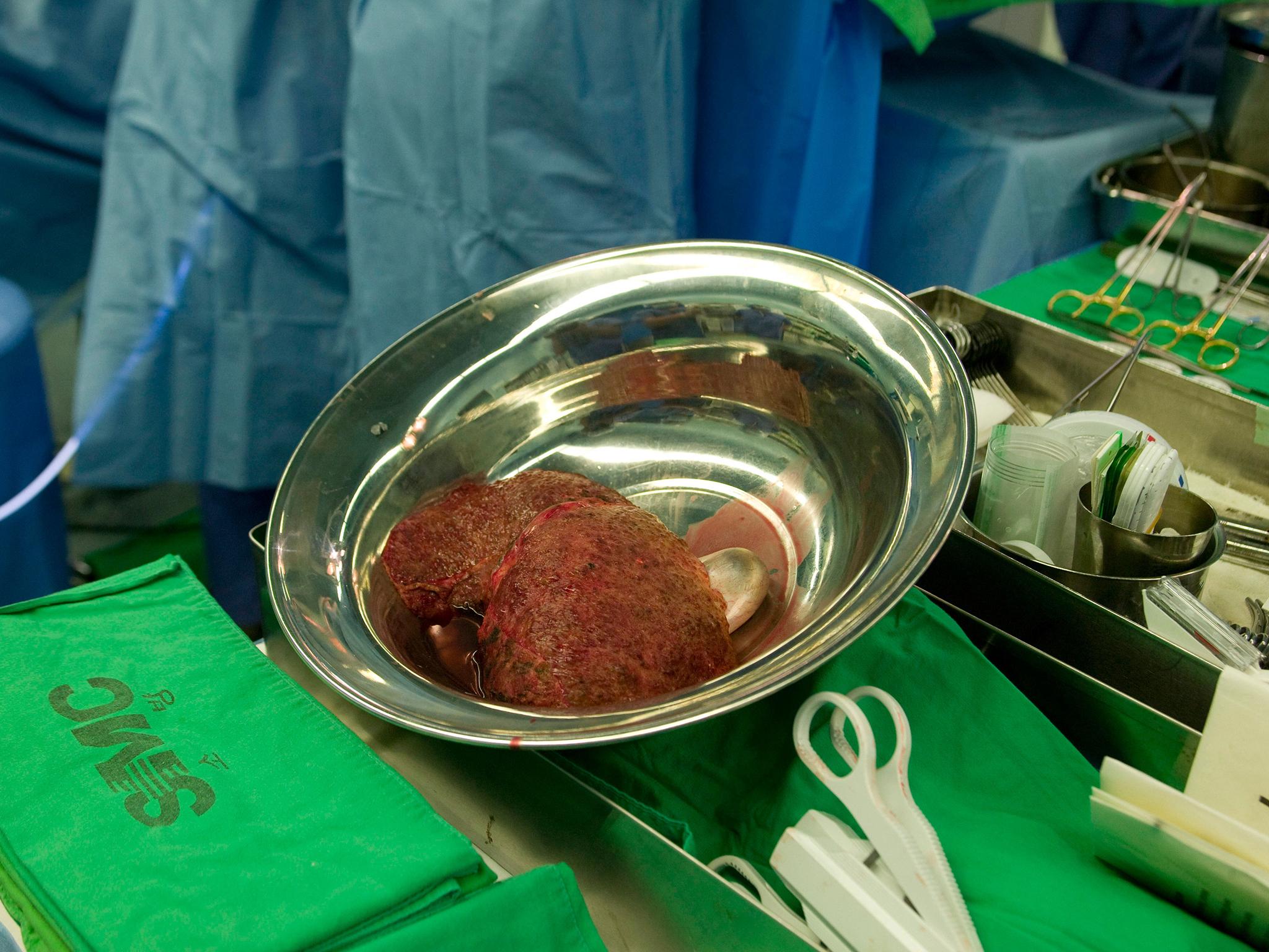 &#13;
Within five years of a liver transplant, 25 per cent of patients on average have died (Alamy)&#13;