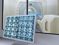 Women’s brains ‘appear three years younger than men’s’ in scans