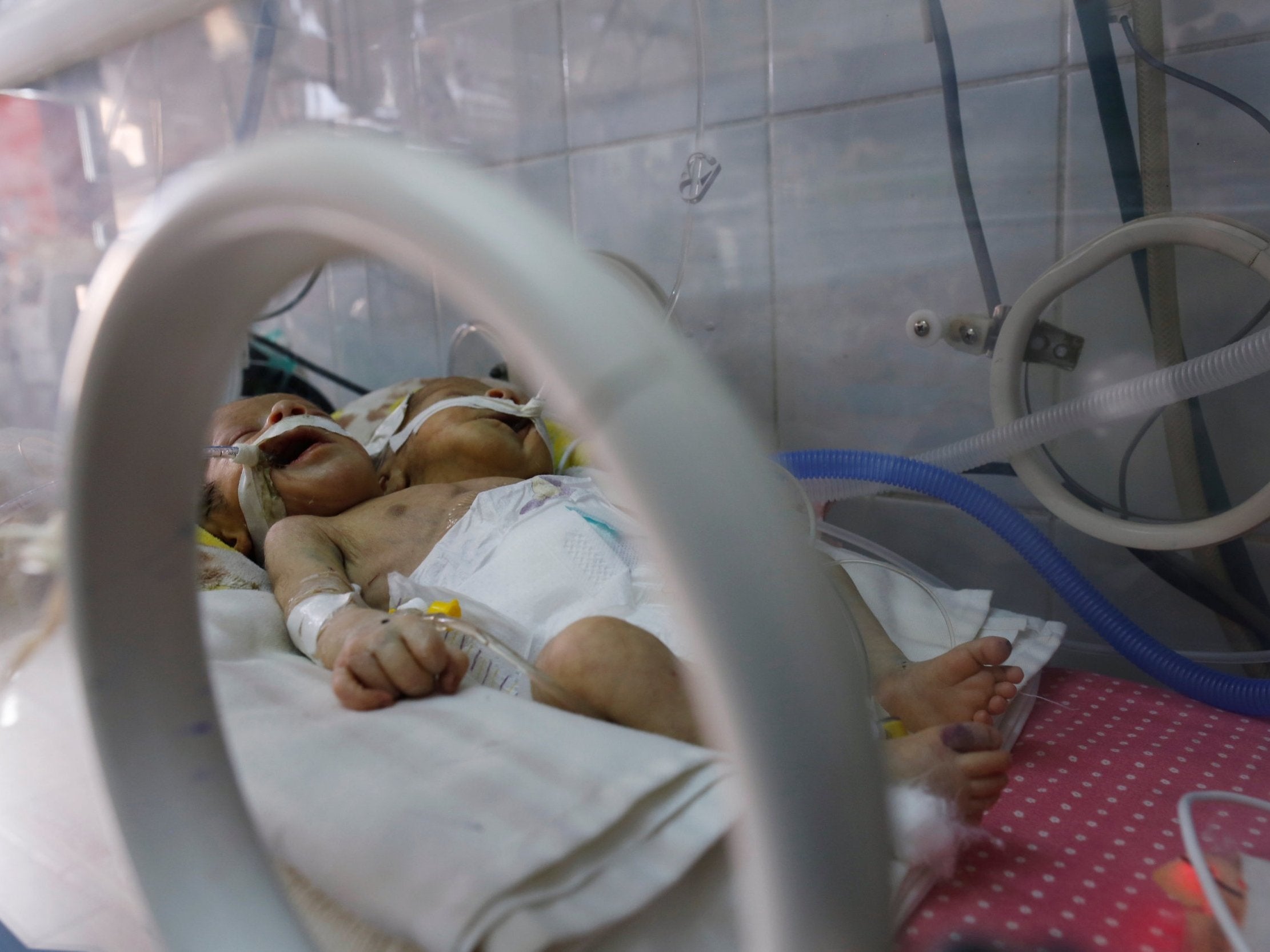 Newly born conjoined twins lie in an incubator at the child intensive care unit of al-Thawra hospital in Sanaa, Yemen