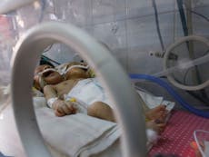 Conjoined twins in Yemen die after not receiving urgent treatment