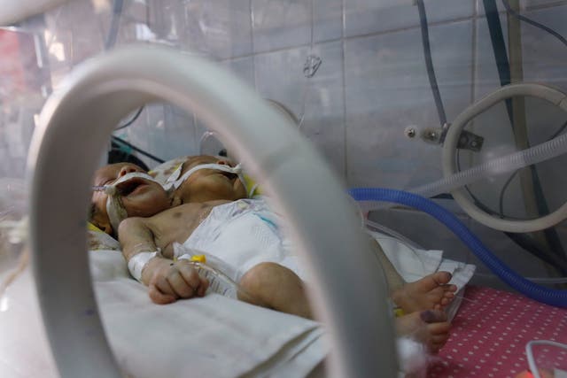 Newly born conjoined twins lie in an incubator at the child intensive care unit of al-Thawra hospital in Sanaa, Yemen