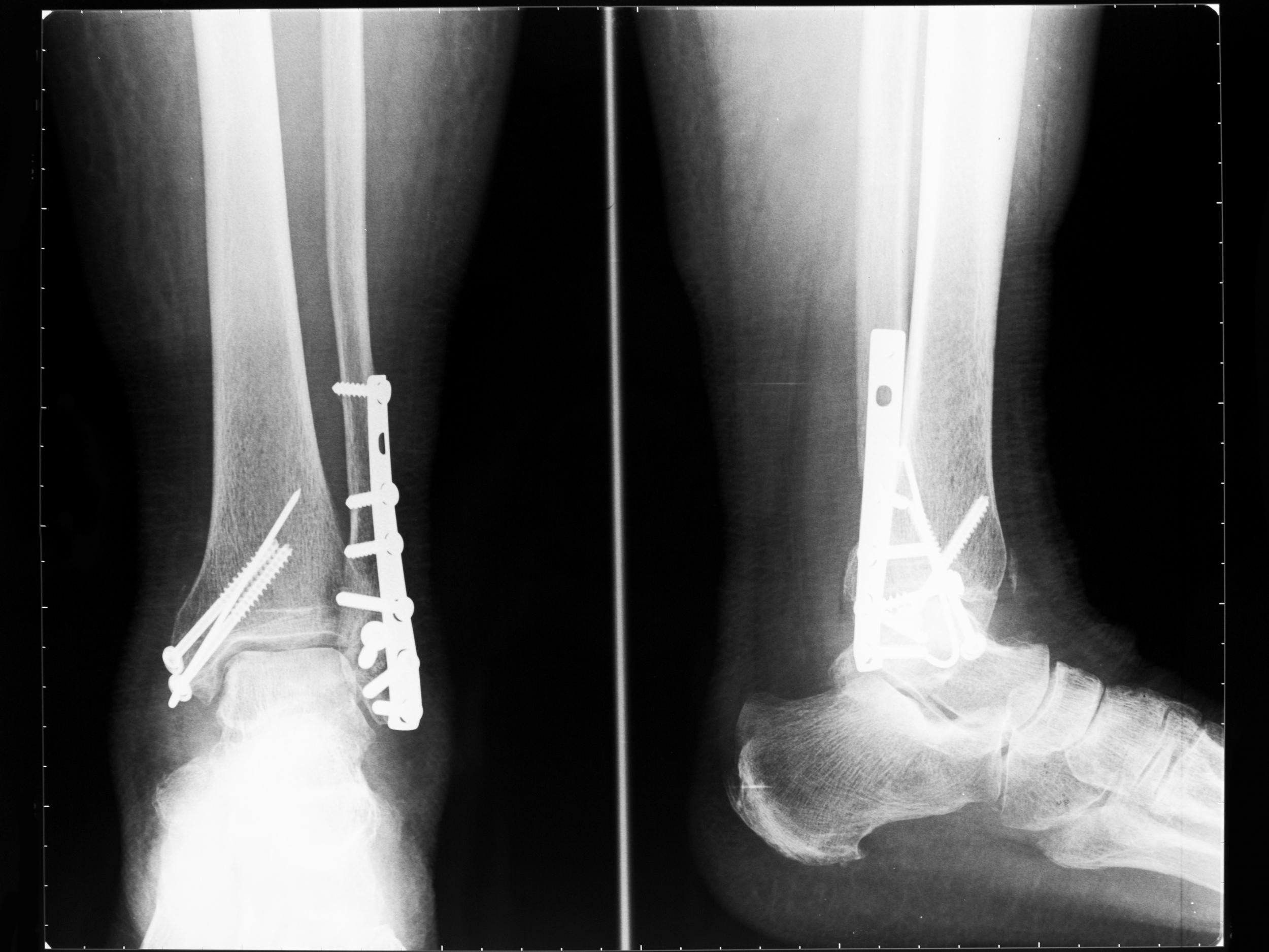 Mix-up meant flexible metal plates meant for complex surgical repairs used for weight-bearing shin, thigh and arm fractures