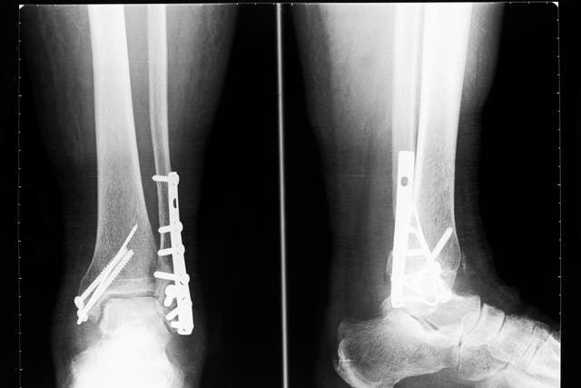 Mix-up meant flexible metal plates meant for complex surgical repairs used for weight-bearing shin, thigh and arm fractures