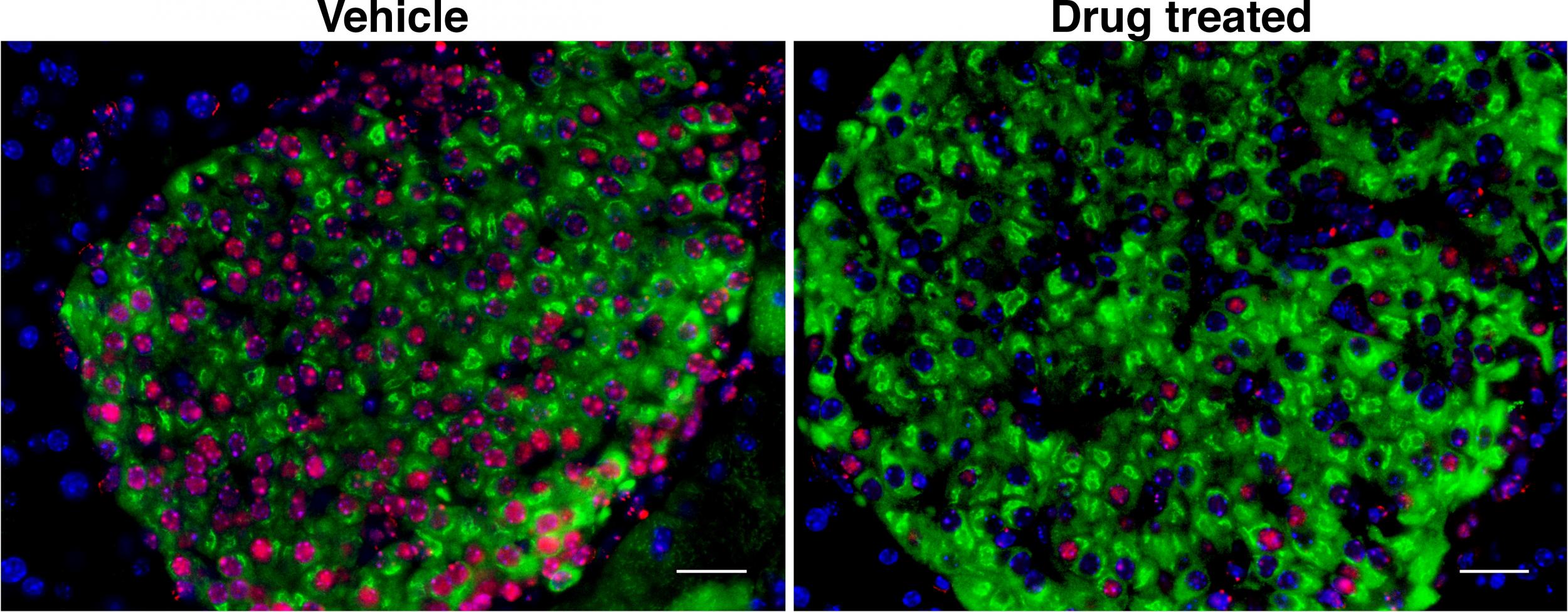 Left: insulin-producing beta cells in the pancreas (green) accumulate DNA damage and become senescent (red), triggering an immune response. Right: pancreatic cells treated with cancer drug that clears senescent cells (Bhushan lab/UCSF)
