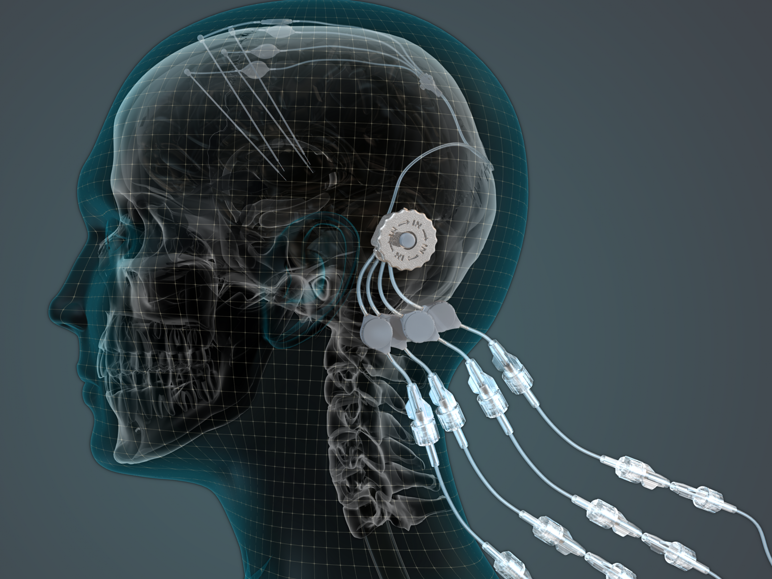 The implant allows drugs to be regularly and painlessly delivered with pinpoint precision to key parts of the brain