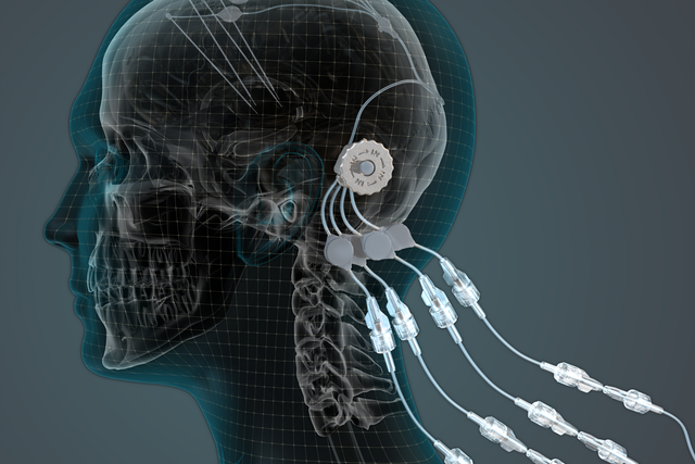 The implant allows drugs to be regularly and painlessly delivered with pinpoint precision to key parts of the brain