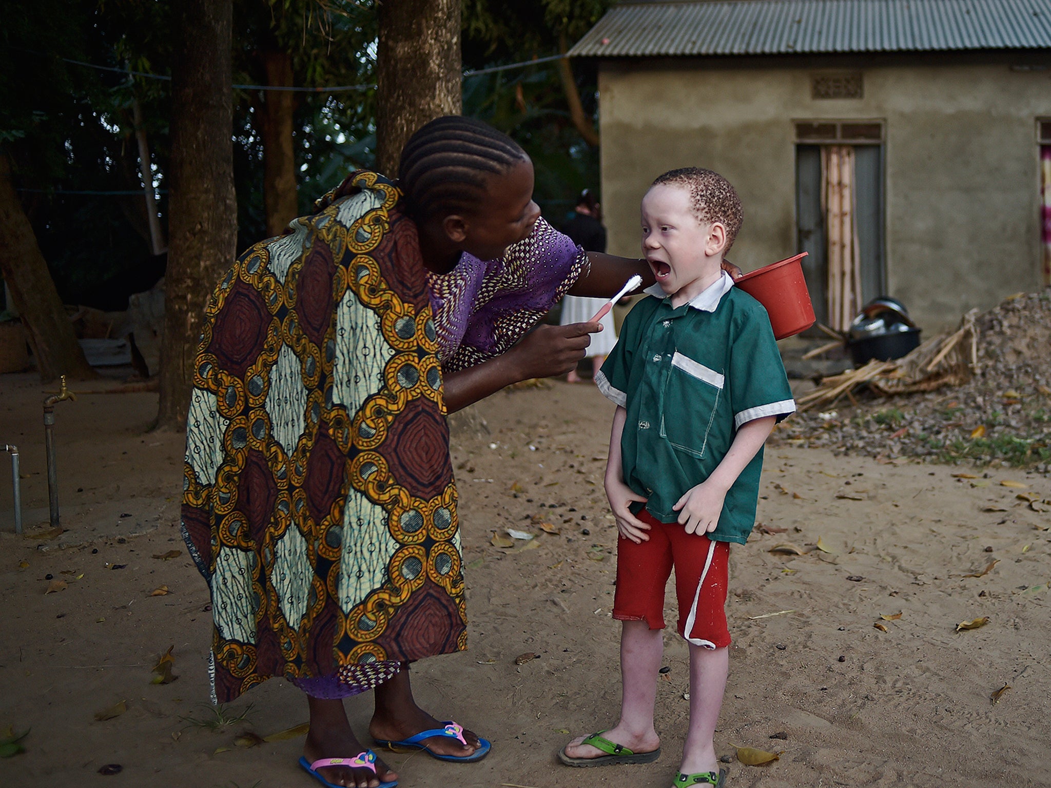 People with albinism are often targeted under the belief their body parts are particularly potent in rituals