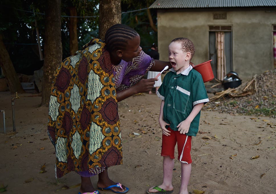 People with albinism are often targeted under the belief their body parts are particularly potent in rituals