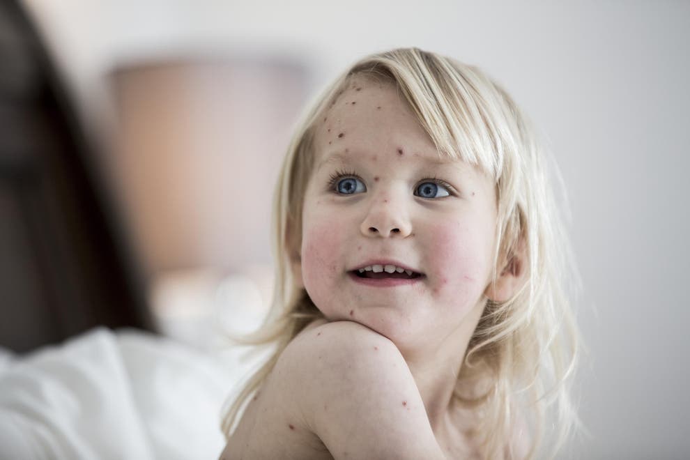 A Guide To Chickenpox The Signs Symptoms And How To Treat It The