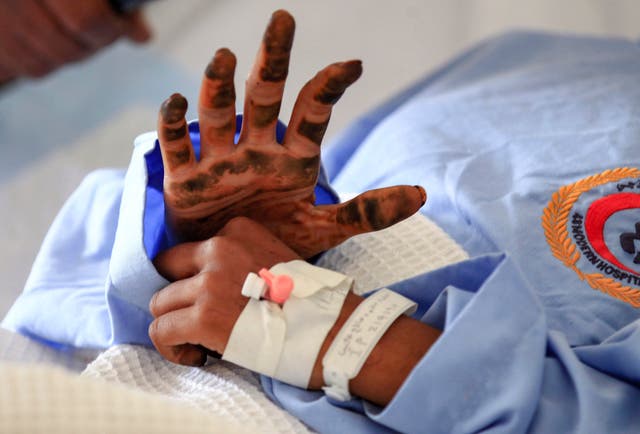 A Yemeni girl receives treatment at a hospital in Sanaa on 11 March, from wounds sustained during a reported air strike