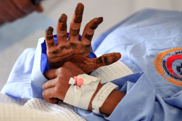 A Yemeni girl receives treatment at a hospital in Sanaa on 11 March, from wounds sustained during a reported air strike