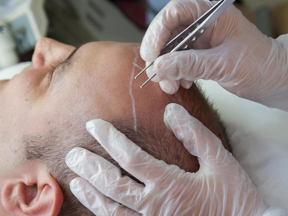 Man dies after 12-hour hair transplant