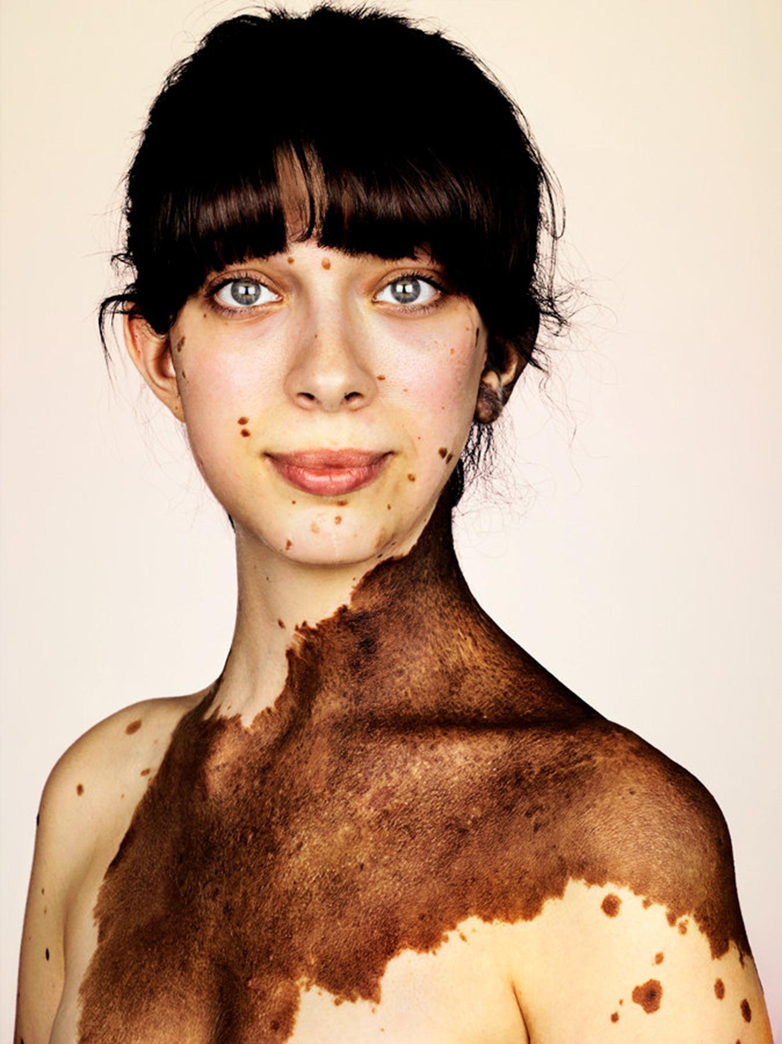 What Is Vitiligo The Rare Skin Condition Explained The Independent