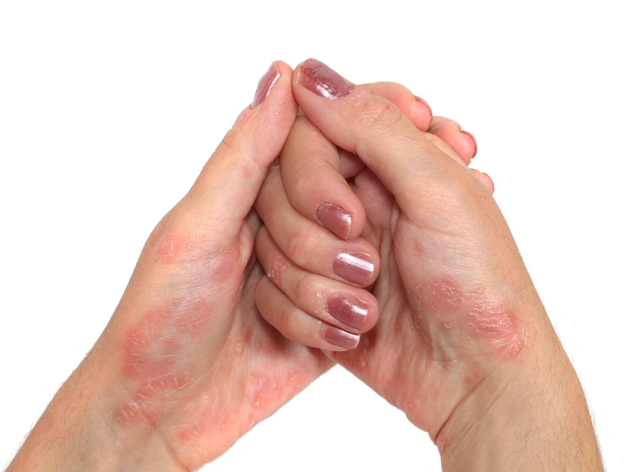 Skin conditions like eczema and psoriasis cause food allergies to occur through touch