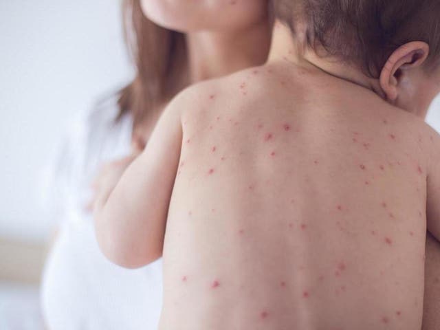 The measles outbreak is the largest of its kind in nearly three decades and stems from communities declining to provide their children with vaccinations, according to officials