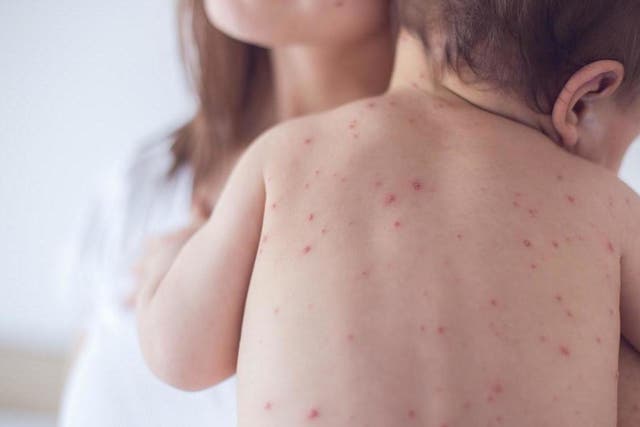 The measles outbreak is the largest of its kind in nearly three decades and stems from communities declining to provide their children with vaccinations, according to officials