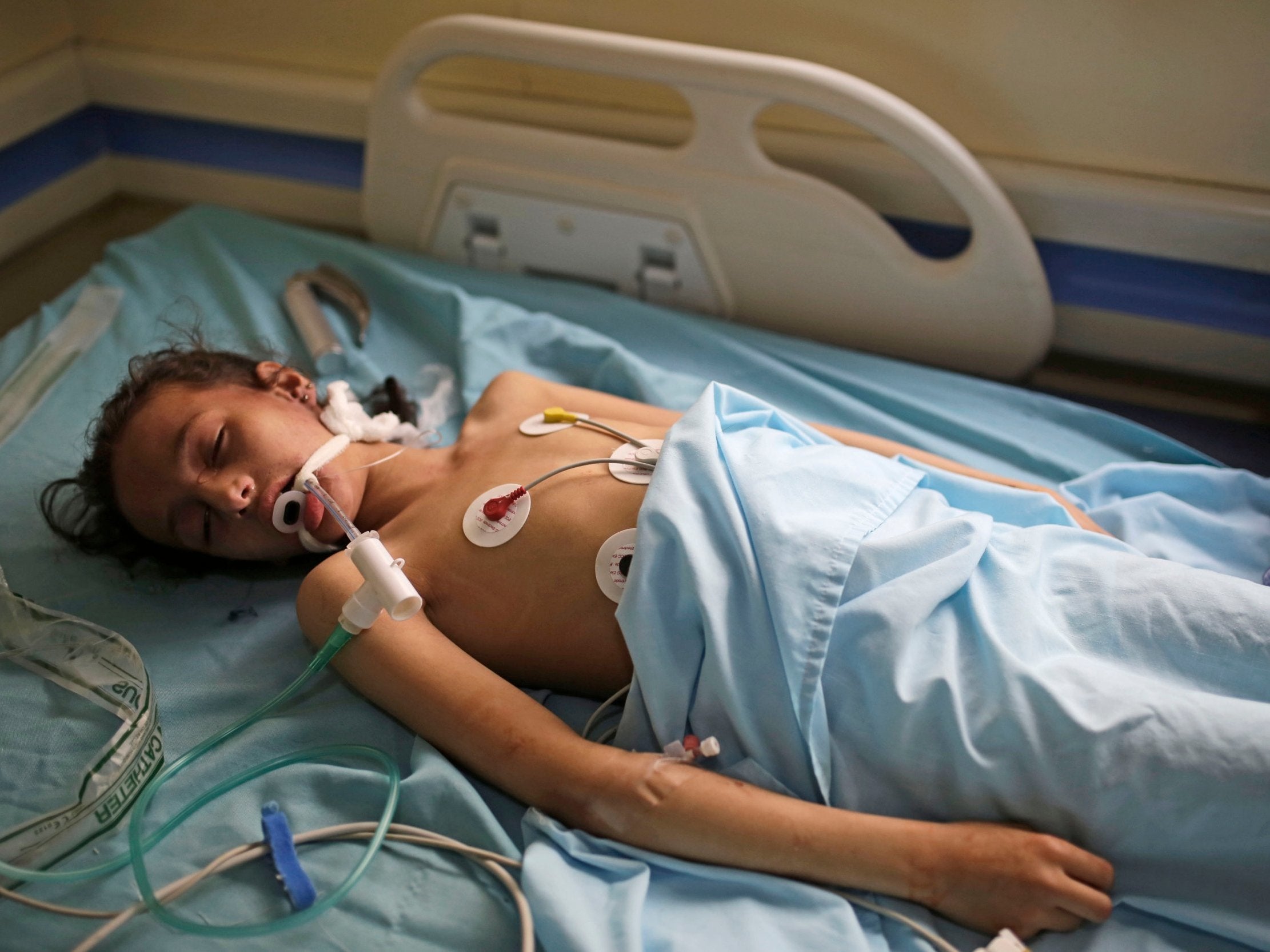 A Yemeni girl injured in the explosion lies in a hospital bed in Sanaa