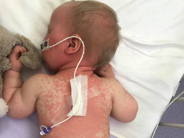 Baby Alba being treated for measles