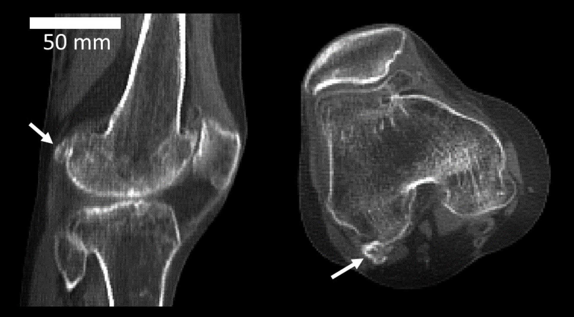 Fabella are small bones which appear in tendons behind the knee cap with no known purpose