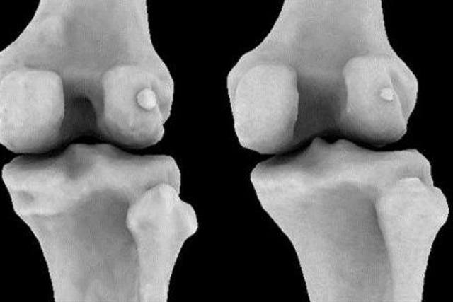 Fabellae (small knee bones behind the knee cap) are twice as common in people with osteoarthritis of the knee