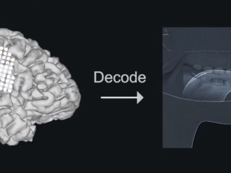 Technology generates synthesised spoken words from brain signals associated with movements of the jaw, larynx, lips and tongue.