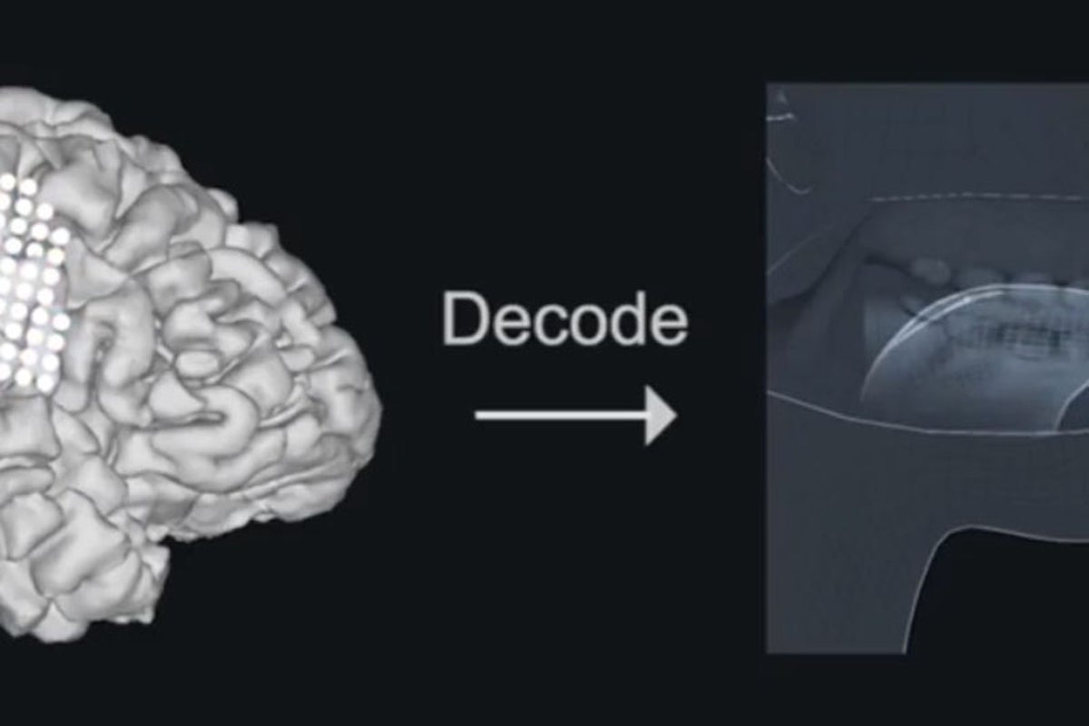Mind-reading voice box could help doctors connect with patients who ...