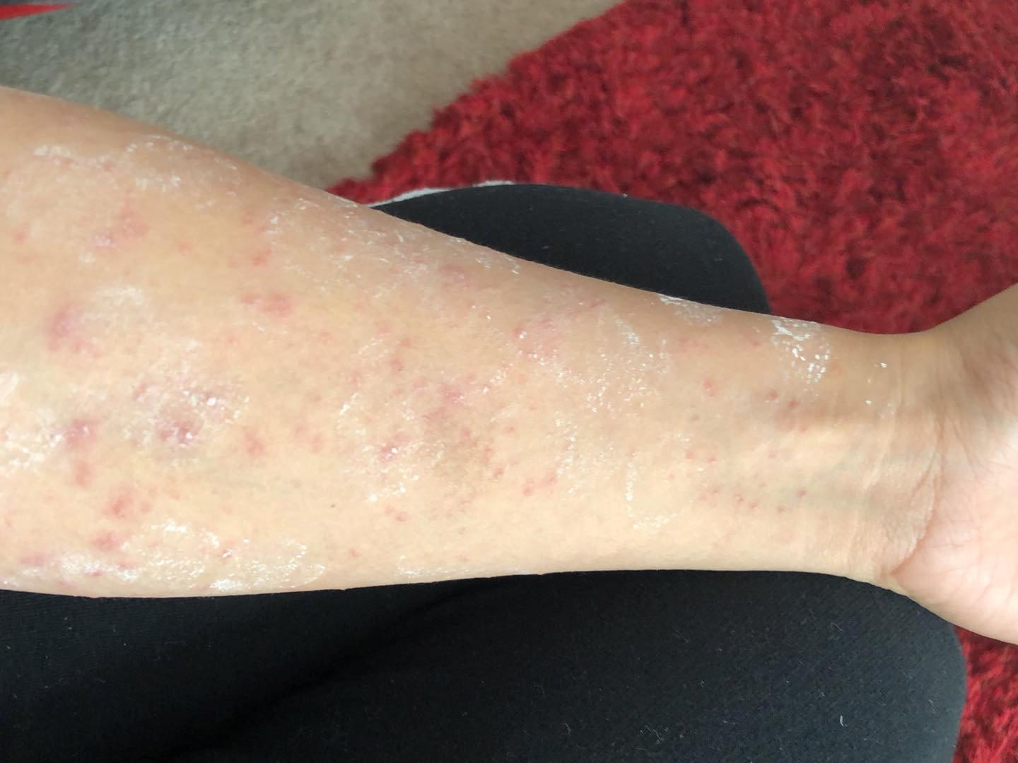 The rash suffered by Britney Comayas, 22, after coming into contact with caterpillar in Milton Keynes ( SWNS)