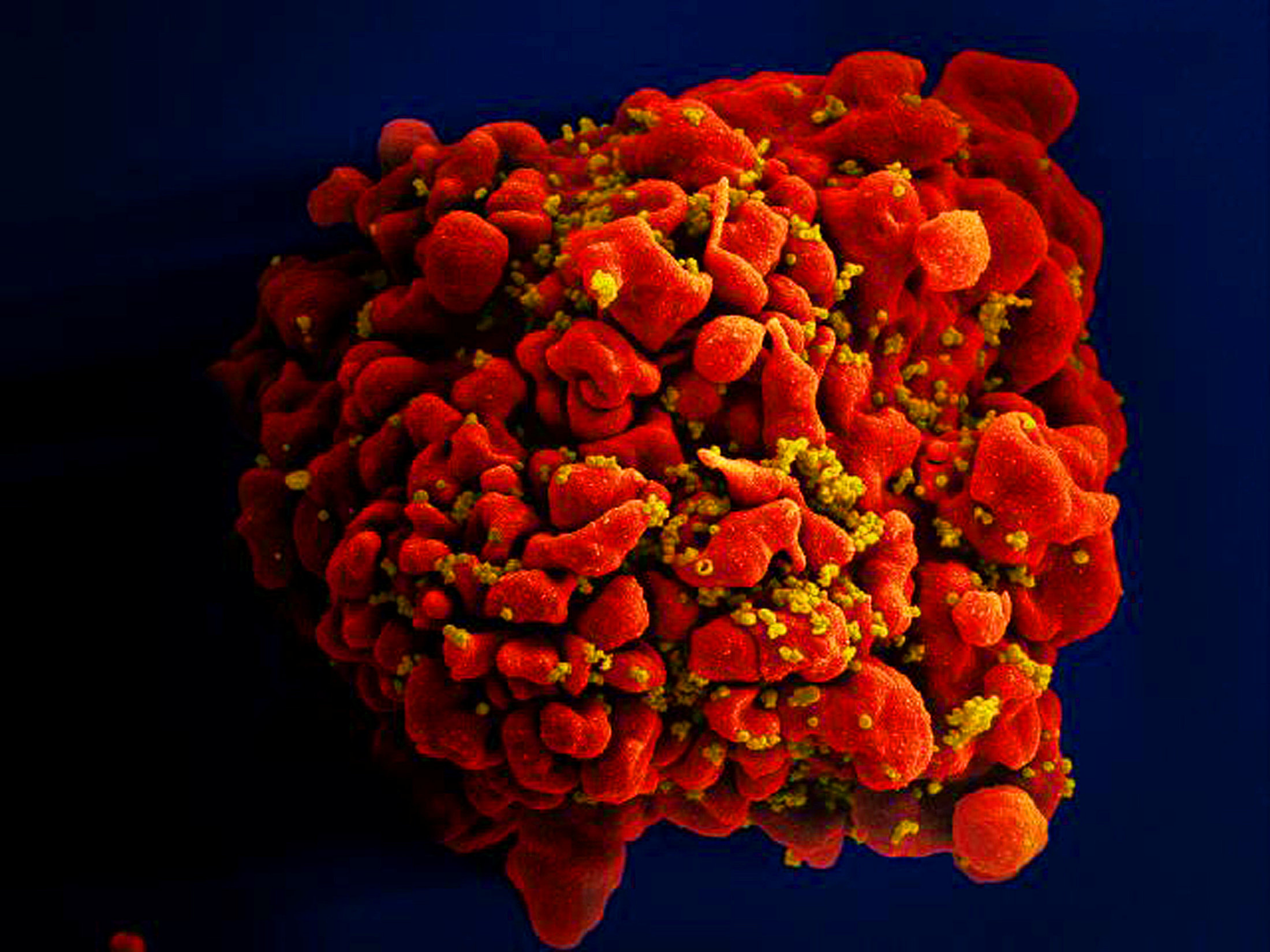 A digitally colorized scan of a red-coloured H9-T cell infected by numerous yellow-coloured HIV particles