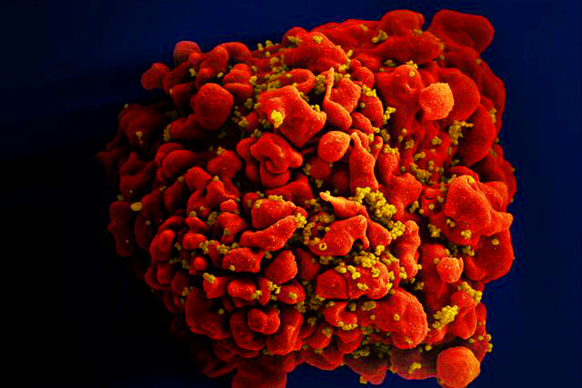 A digitally colorized scan of a red-coloured H9-T cell infected by numerous yellow-coloured HIV particles