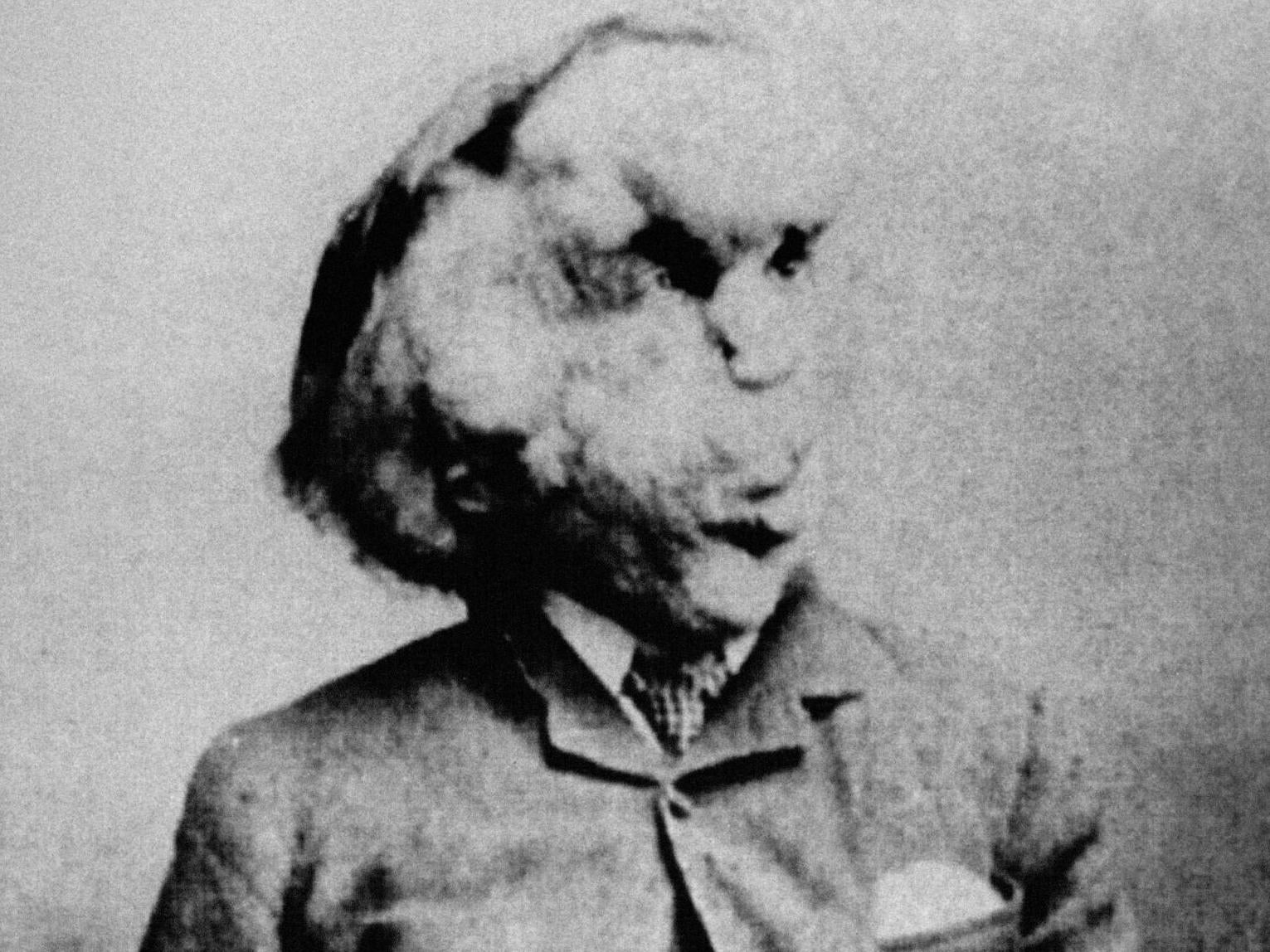 Joseph Merrick, photographed by Radiological Society of North America