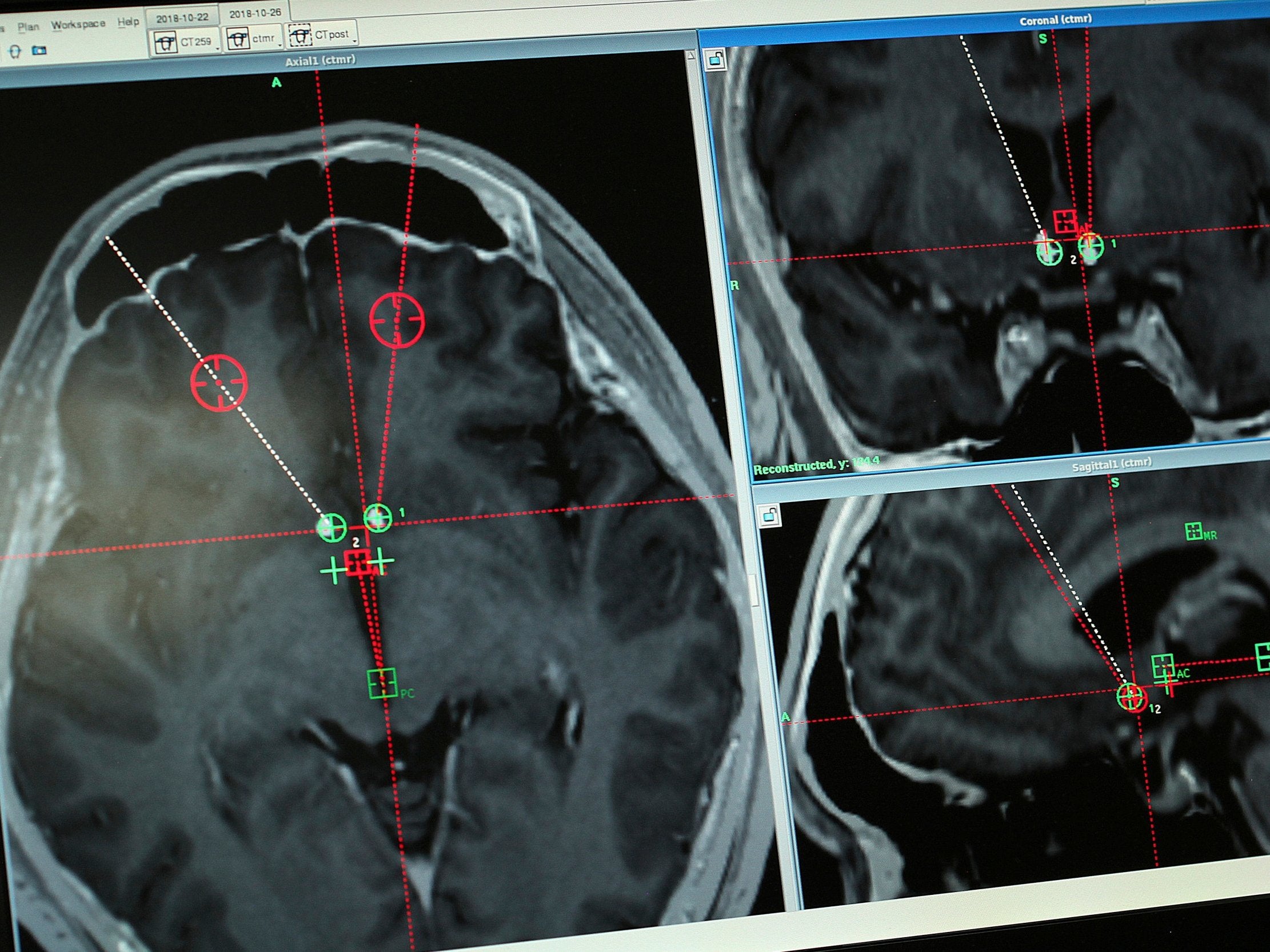 Brain scan of a methamphetamine user with the path of implanted electrodes