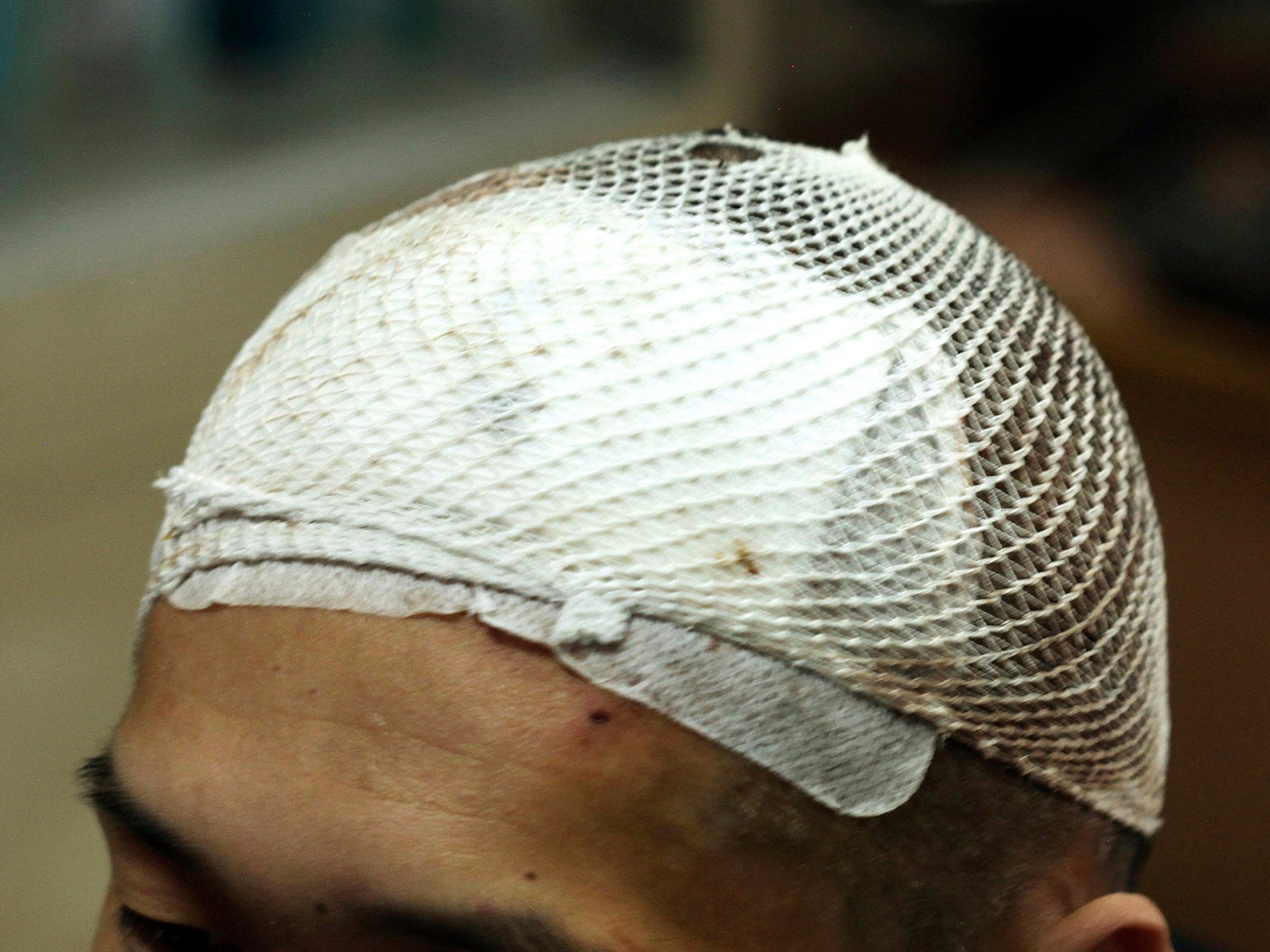 Protective mesh covers head of Chinese patient Yan