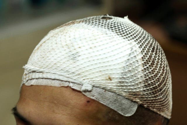 Protective mesh covers head of Chinese patient Yan