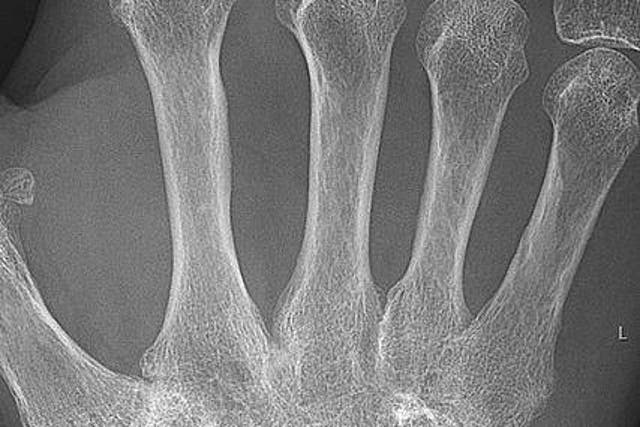 X-ray of the wrist of a 66-year-old woman with rheumatoid arthritis: the BMJ has said regular intake of supplements for arthritis and joint pain may lower the risk of heart disease and stroke
