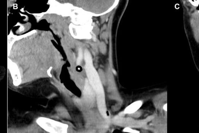 A CT angiogram image depicts the injury sustained by the unidentified pre-teen.