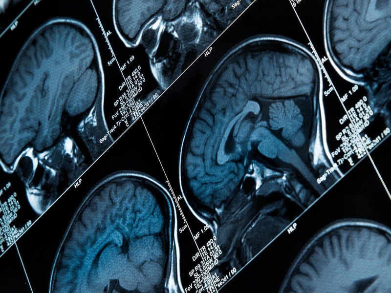 How AI could help detect epilepsy before radiologists