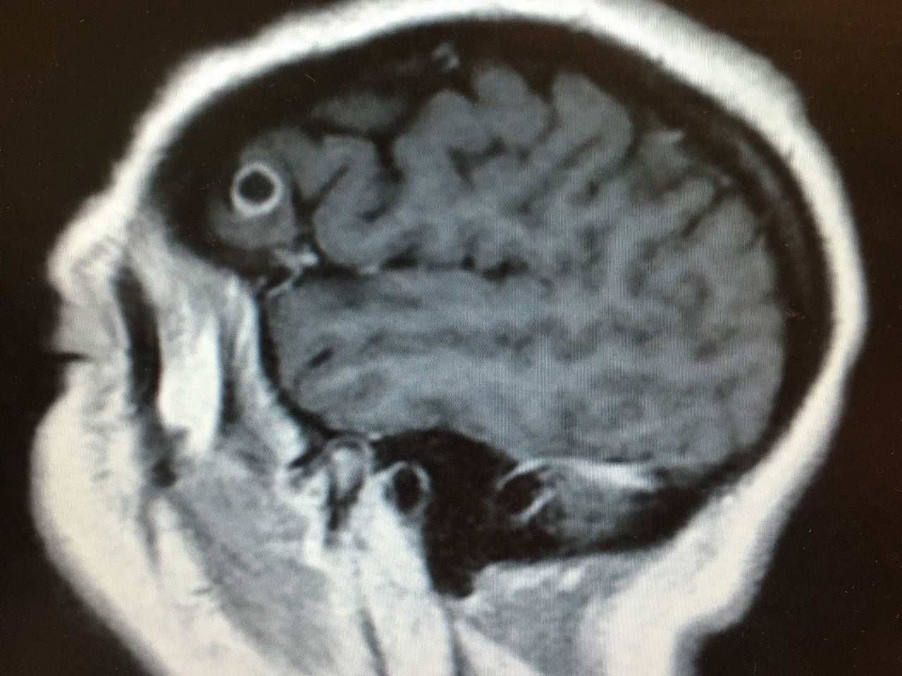 A scan shows the tapeworm in Rachel Palma's brain