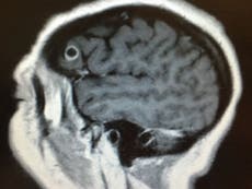 Doctors opening patient’s skull to remove brain tumour find tapeworm instead