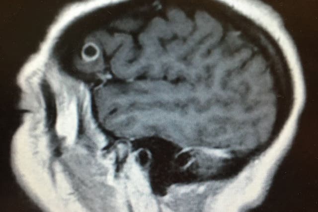 A scan shows the tapeworm in Rachel Palma's brain