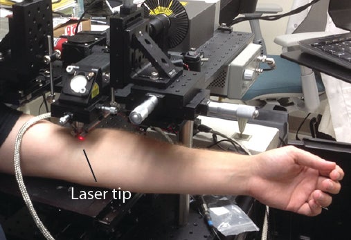 The researchers applied their laser-based technique to detect circulating tumor cells in the veins of patients with melanoma