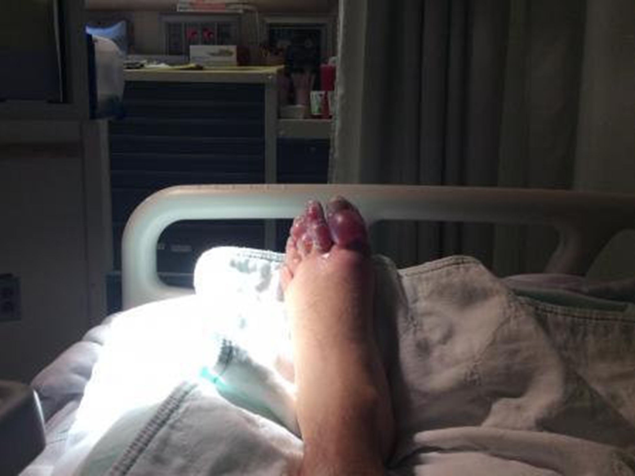 Nick Griffiths had to have three toes amputated after suffering from severe frostbite