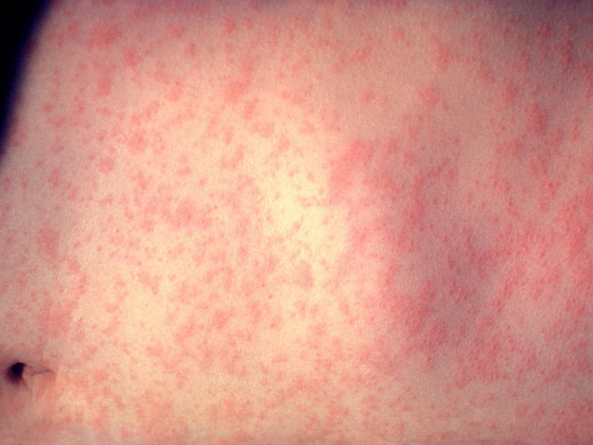 Measles outbreak in town where locals believe God forbids vaccinations