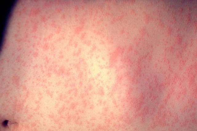 Related video: World Health Organisation warns of global rise in measles cases