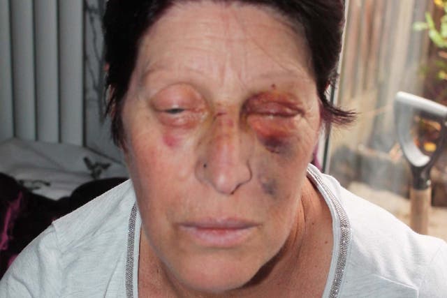 Joy Watson was left with a broken eye socket after attack